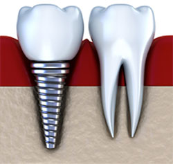 dental-implants