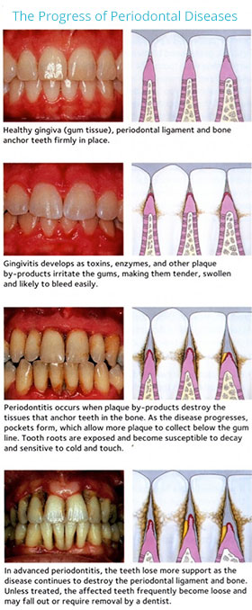 The 5 Stages of Gum Disease: Signs, Symptoms, and Treatment - Old