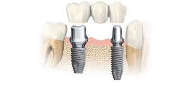 Implant Services